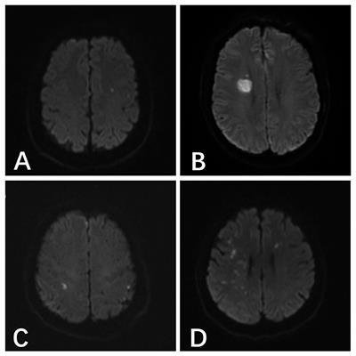 The Utility of Diffusion-Weighted MRI Lesions to Compare the Effects of Different Heparinization Schemes in Intracranial Aneurysms Treated by Endovascular Intervention